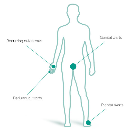 Types of warts