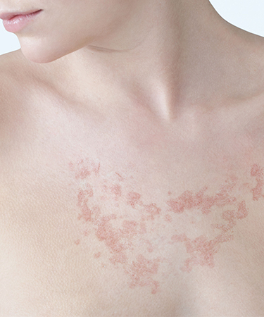 FotoUltra ISDIN Solar Allergy