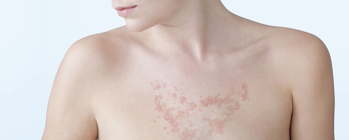 FotoUltra ISDIN Solar Allergy