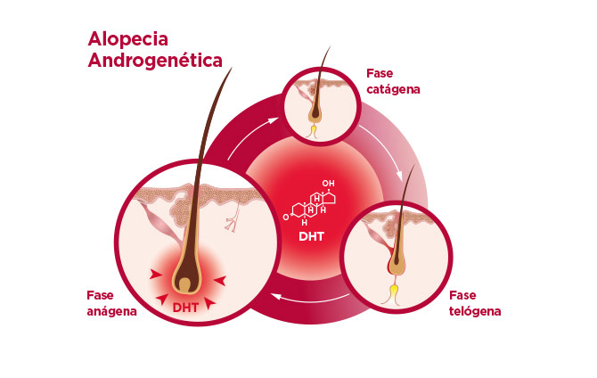 alopecia androgenética caída del cabello
