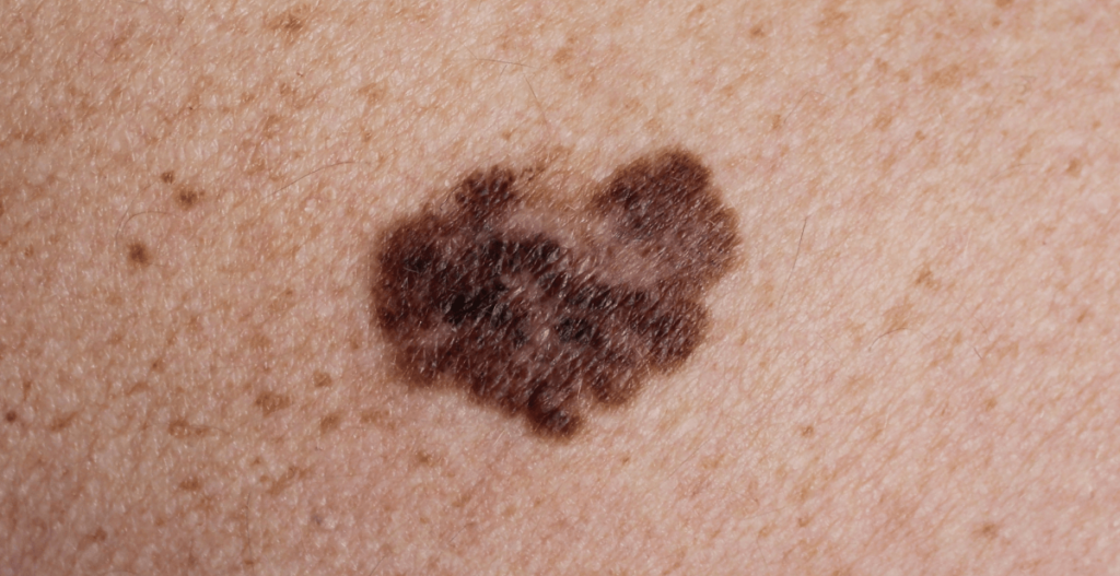 Melanoma