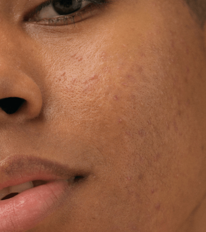Hiperpigmentación post-inflamatoria