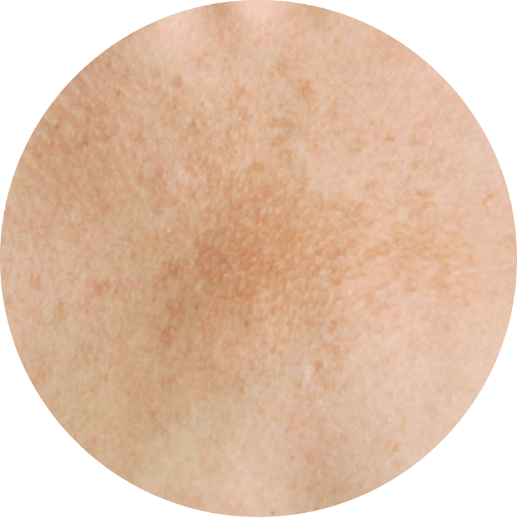 melasma