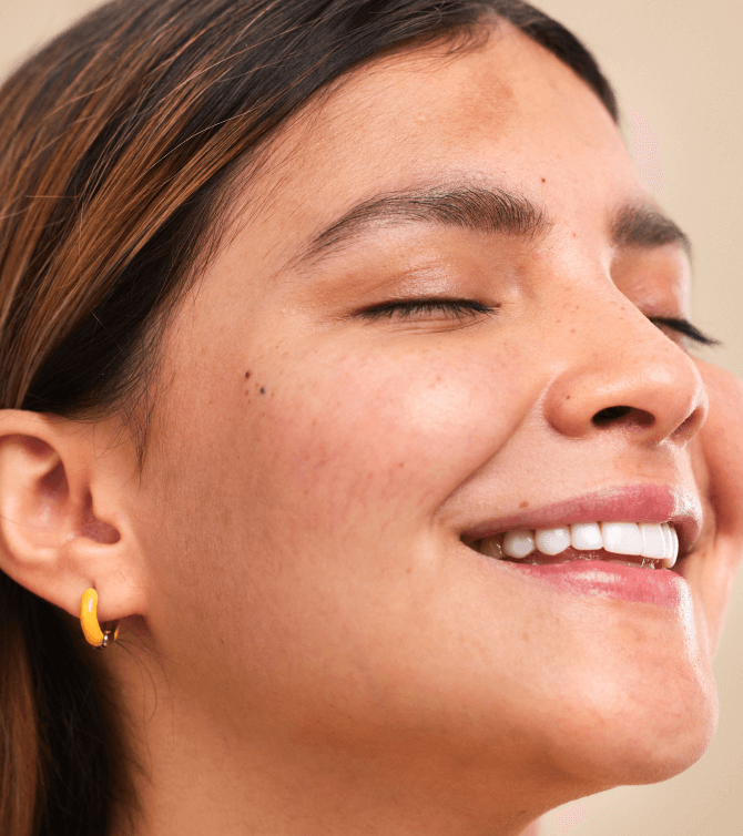 melasma gestacional