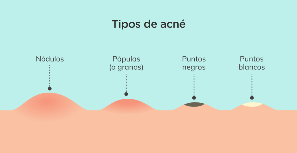 Tipos de acné