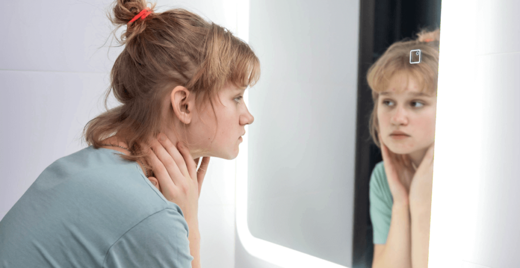tener acné en la adolescencia