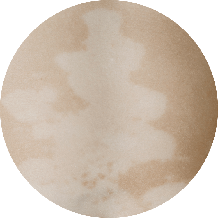 manchas vitiligo