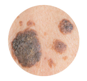 What is Melanoma?