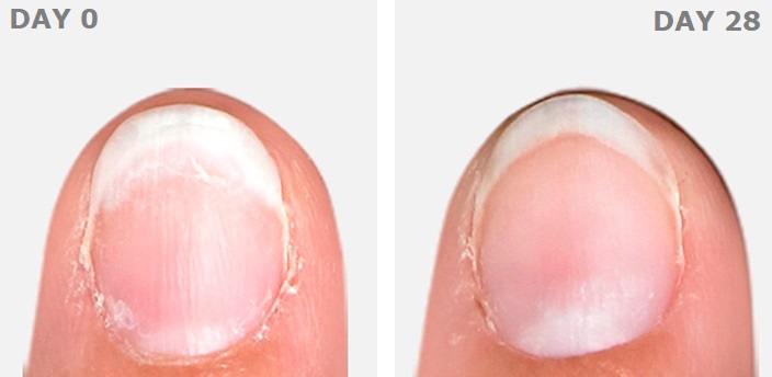 Nail strengthening treatment before and after with ISDIN Si-Nails