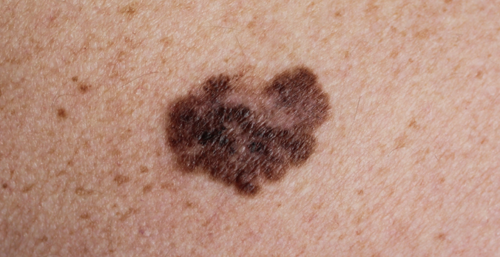 Signs and symptoms of melanoma ISDIN