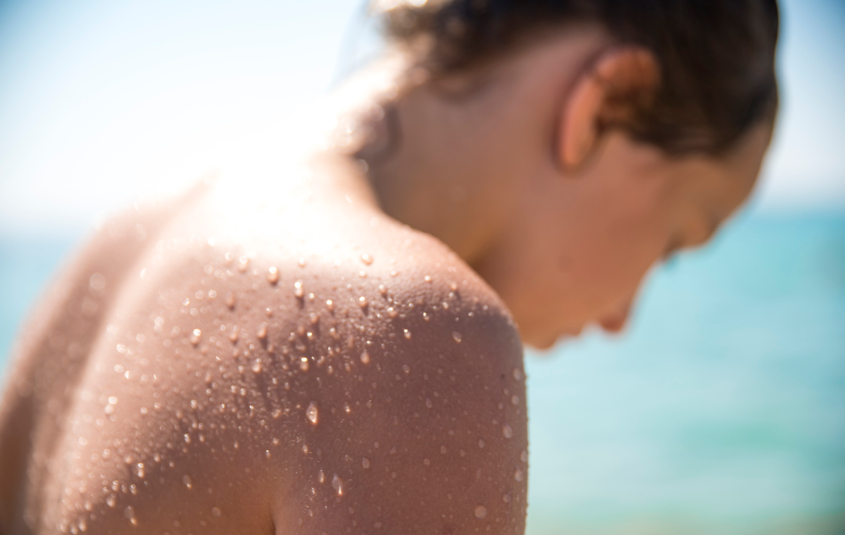 Sun Allergy Q&A: What to Know Before Summertime