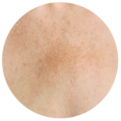 manchas en la piel melasma manchas en la piel melasma