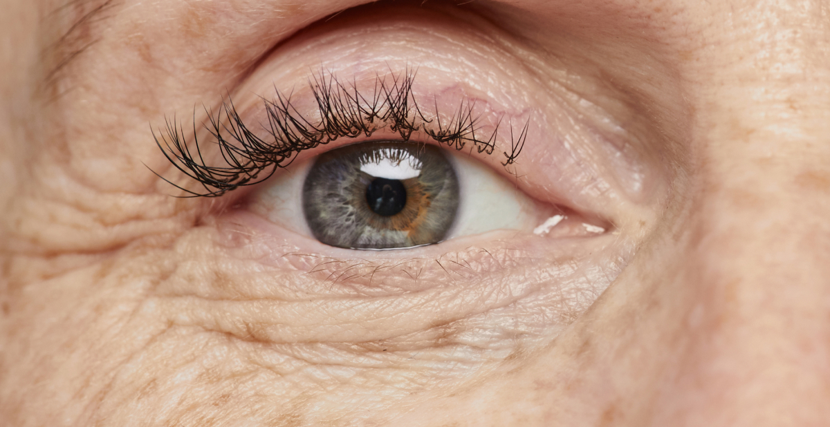 queratosis actínica ojo humano de cerca con pecas color azul