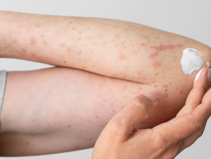 Primer plano de un brazo con enrojecimiento y pequeñas lesiones; una mano aplica crema blanca sobre la piel afectada por dermatitis atópica