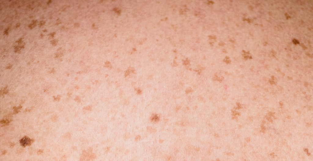 aspecto manchas solares en la piel