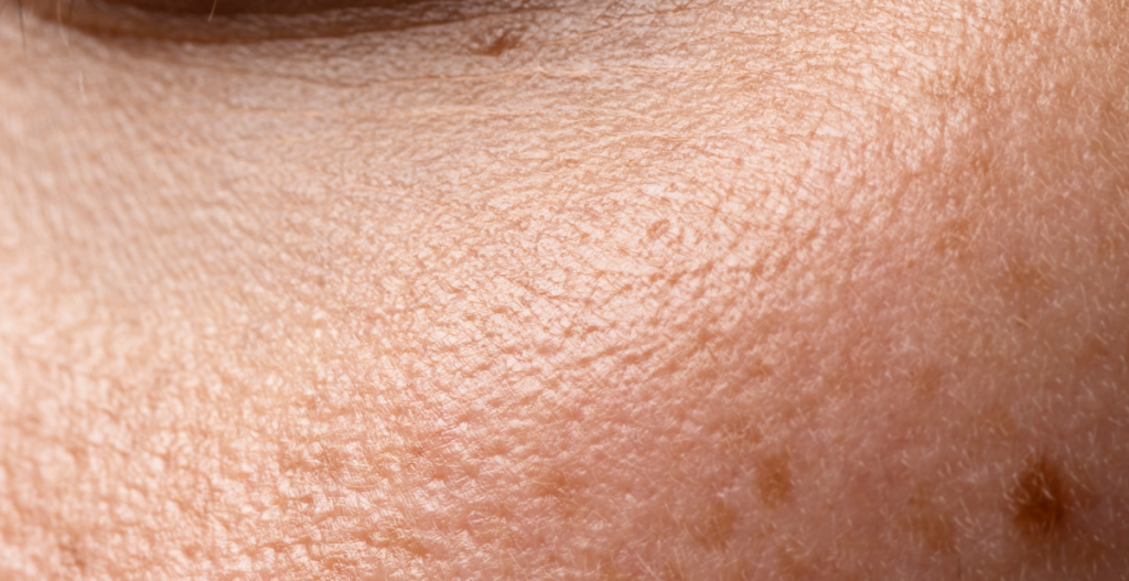 Primer plano de la piel con manchas visibles e irregularidades en el tono, mostrando el tipo de hiperpigmentación que los productos ISDIN ayudan a tratar