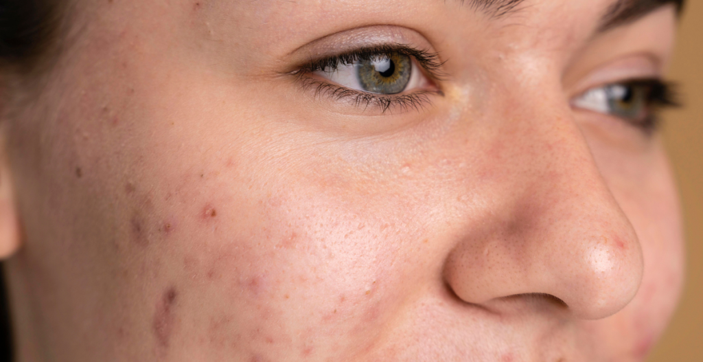 tipos de granos de cerca en piel de chica joven de ojos azules y verdes