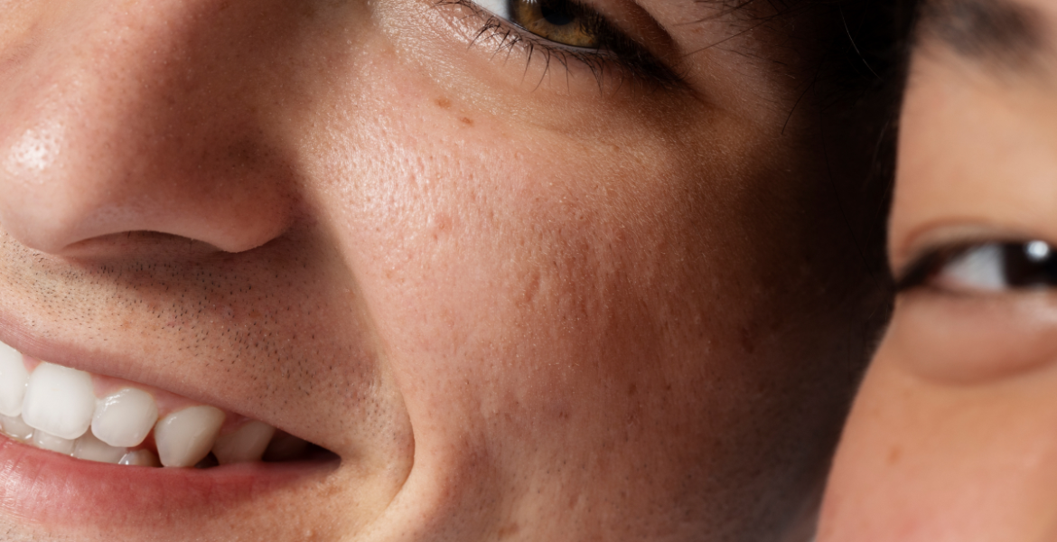 qué son los poros de la piel