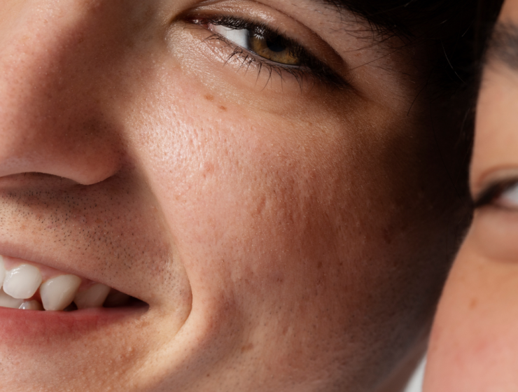 qué son los poros de la piel