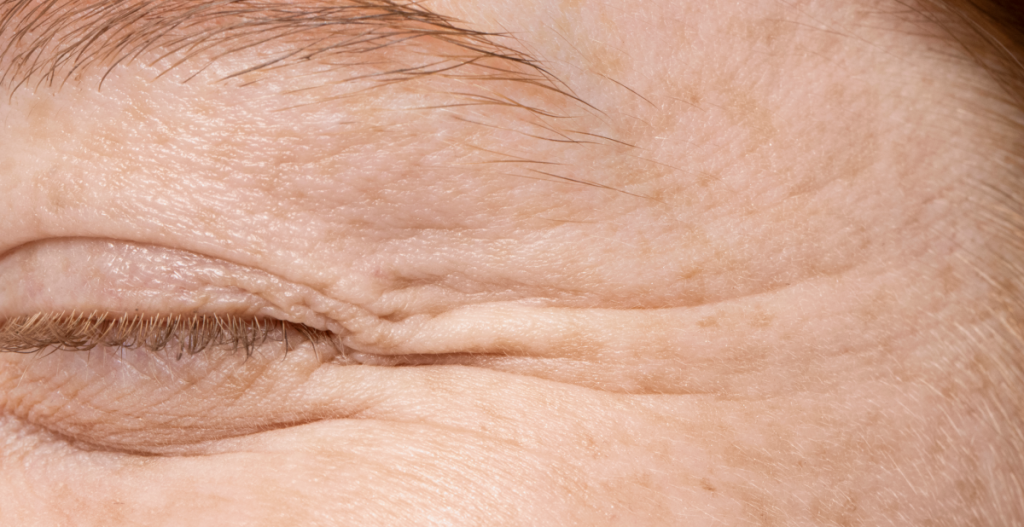 Primer plano del contorno de ojos con patas de gallo y líneas finas de expresión