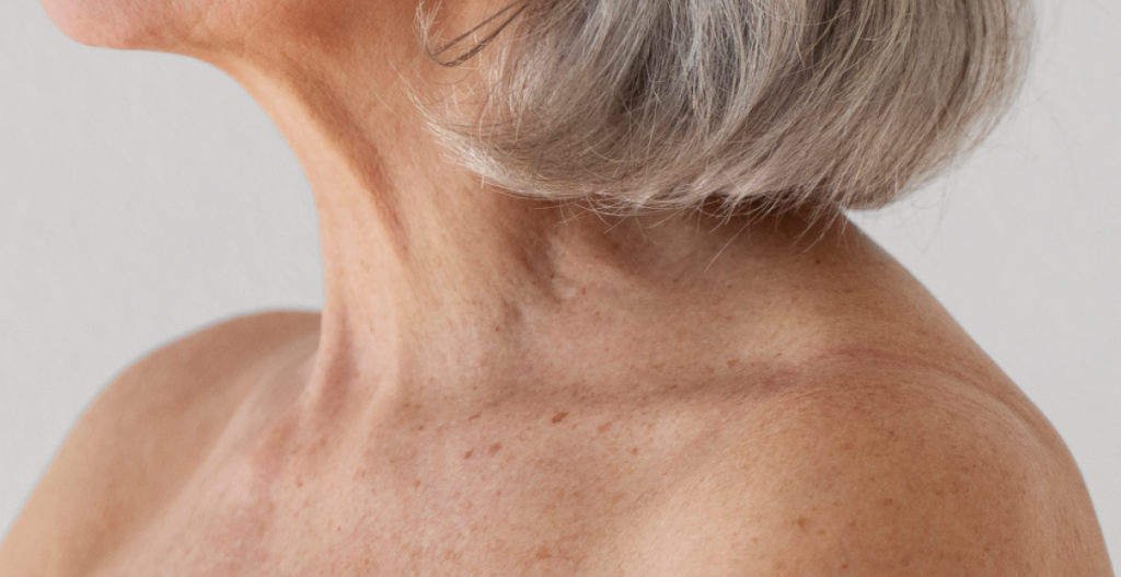 Cuello y escote con arrugas, manchas solares y signos de pérdida de firmeza
