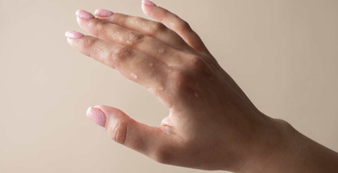 Mano con gotas de sudor, imagen principal sobre hiperhidrosis en manos y pies.