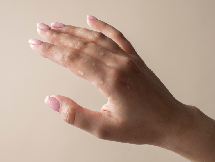Mano con gotas de sudor, imagen principal sobre hiperhidrosis en manos y pies.