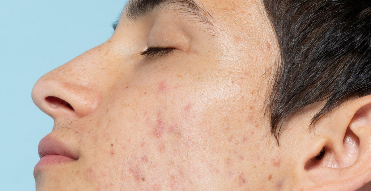 Primer plano de una persona con imperfecciones y marcas de acné visibles en la mejilla.
