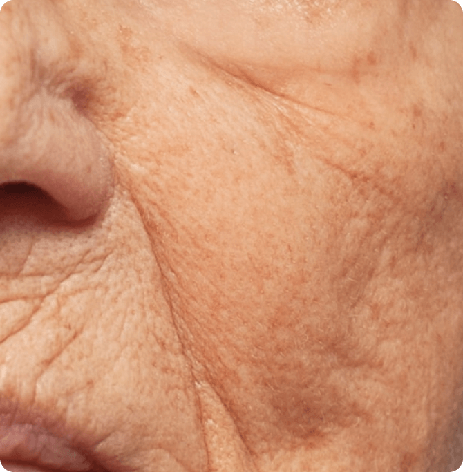 wrinkles are signs of photoaging