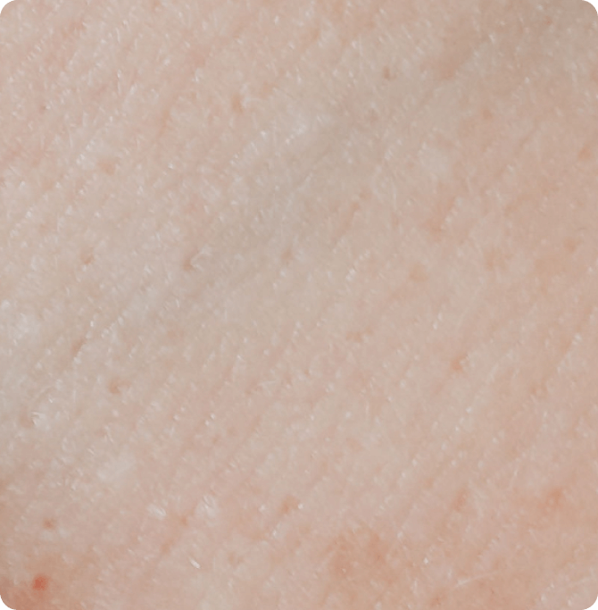 dullness is a sign of photoaging