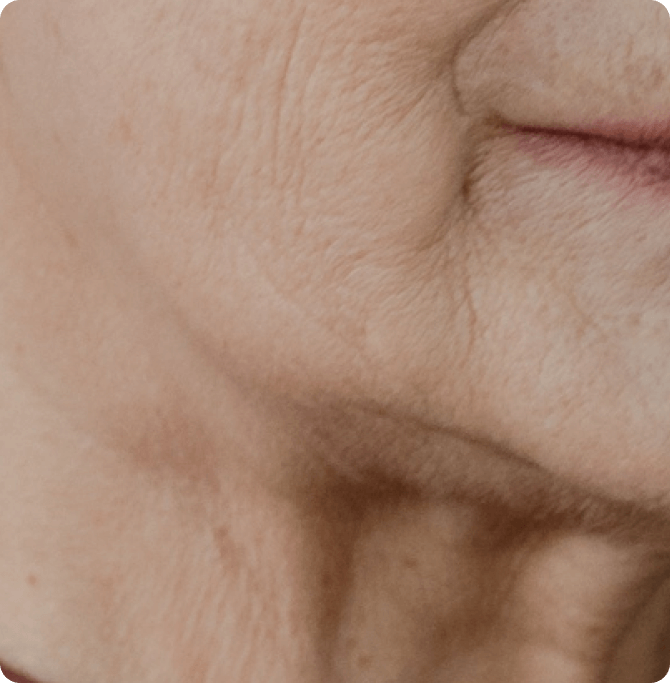 sagging is a sign of photoaging