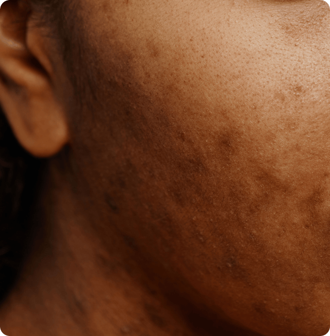 dark spots are signs of photoaging