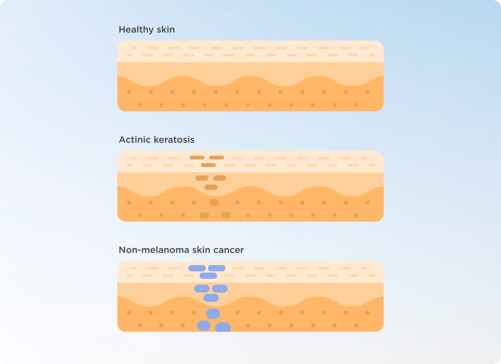¿Qué es la queratosis actínica o el daño actínico?