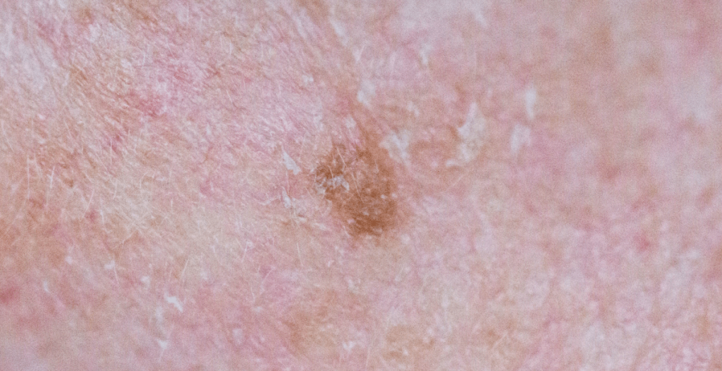 ¿Cómo se ve la queratosis actínica?