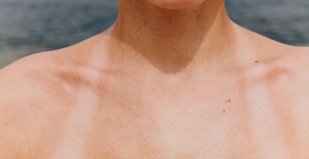 The tanned skin on a person's chest and shoulders with visible tanning lines taken on the beach.