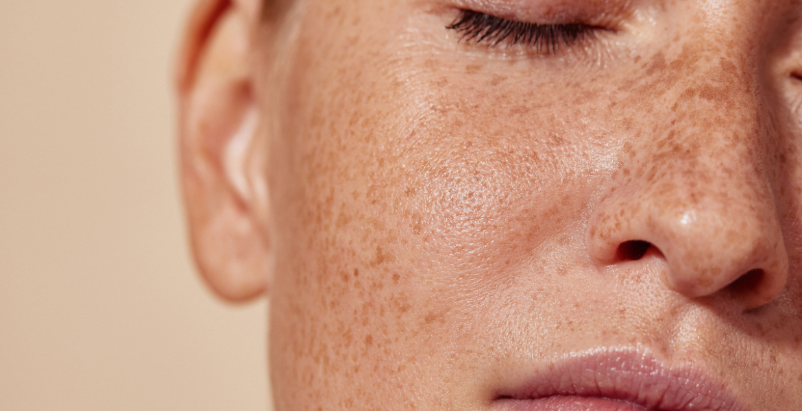 Extreme close-up of a person’s cheek with freckles and smooth skin texture under natural lighting.