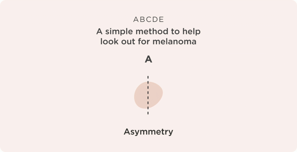 ABCDE Melanoma