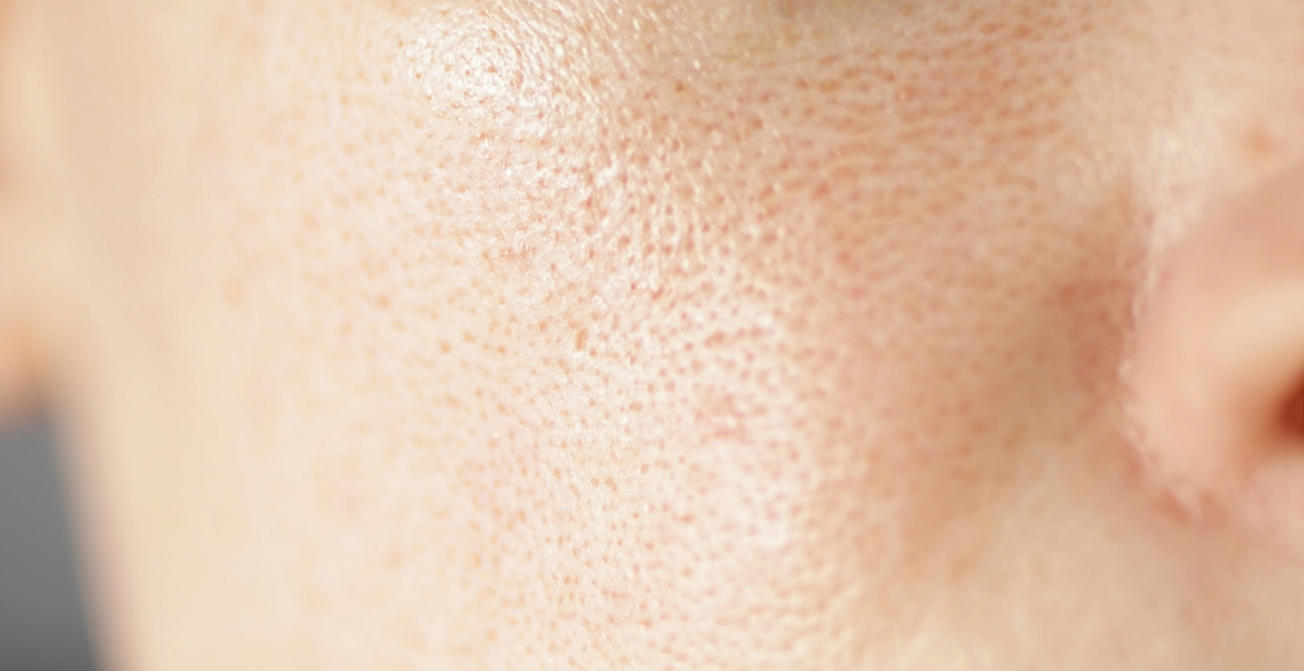 Oily skin with large pores