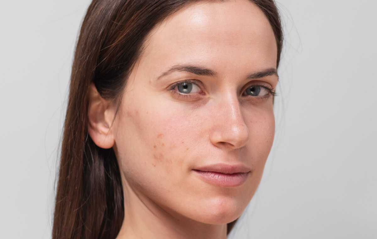 Why Adult Acne Happens and How to Care for Breakout-Prone Skin