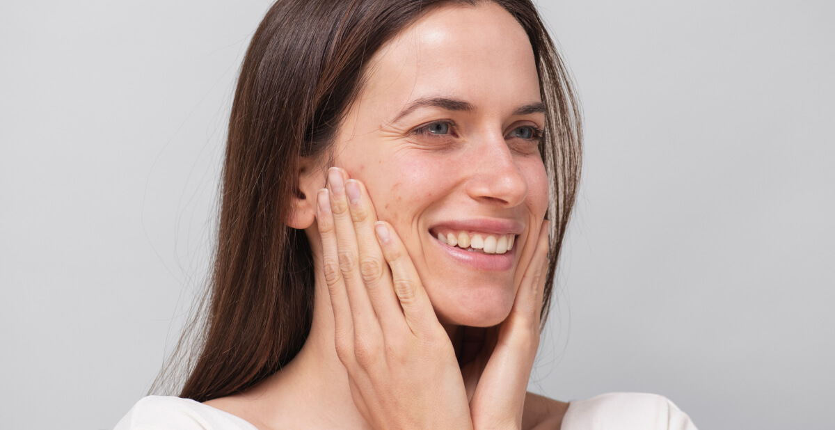 Woman with acne