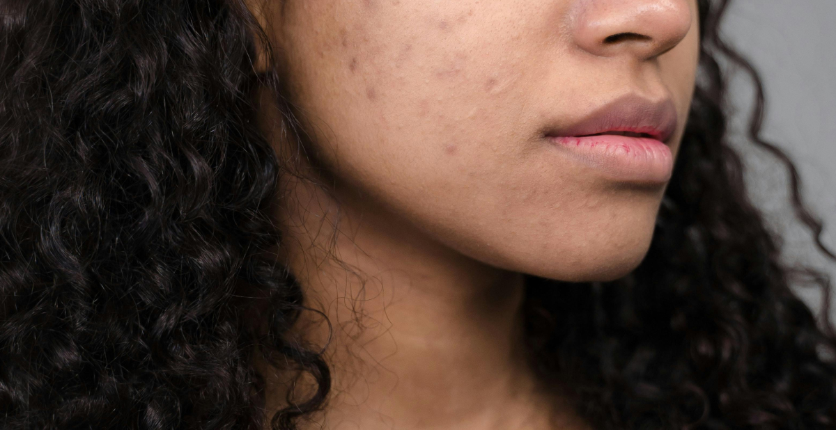 Adult acne on cheek